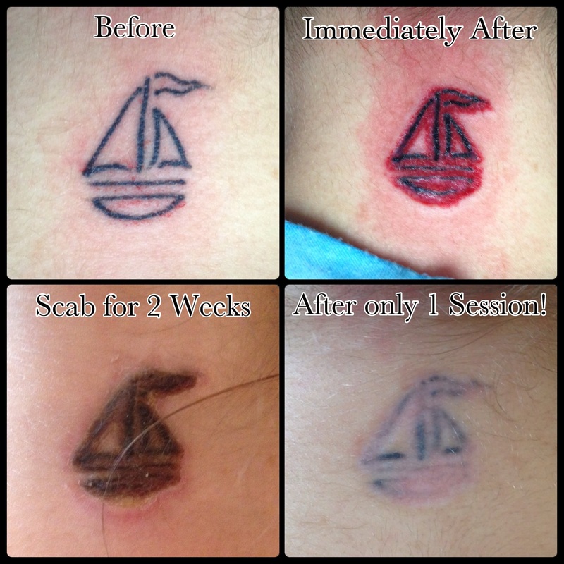 Tattoo Infection Before After - 1000+ Geometric Tattoos Ideas